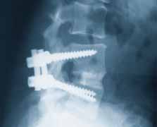 Evaluación radiográfica Amplitud del movimiento Este estudio es el primero y el único que investiga la amplitud del movimiento en un dispositivo de artroplastia vertebral como criterio primario de