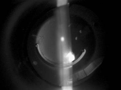 Implantación de anillos intracorneales y lente intraocular para la corrección de la degeneración marginal corneal pelúcida con alta miopía raba obtener una mejoría significativa de la agudeza visual