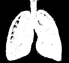 conductos respiratorios Causas alérgicas Tuberculosis Destrucción del tejido Silbido al respirar Falta de