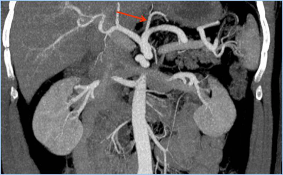 Fig. 9: Arteria gástrica izquierda Irriga al hígado en un 25% de los pacientes: - Como arteria hepática accesoria. - En sustitución de la arteria hepática izquierda. 2.1.c. Arteria esplénica: Es la rama de mayor longitud del tronco celíaco, con un trayecto muy tortuoso en adultos.
