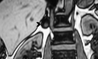 rtículo por Invitación En PET-CT el grado de captación de las glándulas suprarrenales comprometidas tiende a ser paralelo al compromiso extraadrenal, y la captación rápidamente decrece luego de