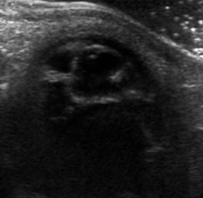 ANOMALÍA DE PETERS En el 80% de los casos se presenta de forma bilateral, aunque asimétrica, cursando con alteración de la cara posterior de la córnea, del iris y
