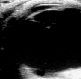 COLOBOMA El coloboma congénito se produce por un cierre incompleto de la cisura coroidea embrionaria.