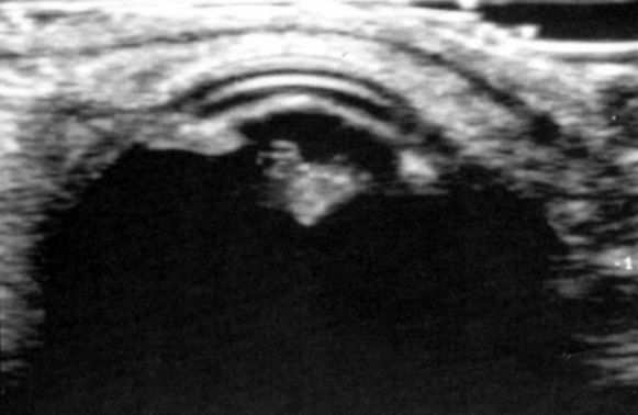 LENTICONO POSTERIOR Defecto adquirido de etiología idiopática, aunque probablemente secundario a una tracción de la parte posterior del cristalino por un remanente de la arteria hialoidea.