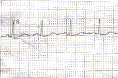 8 En el electrocardiograma puede observar la presencia del punto J, con