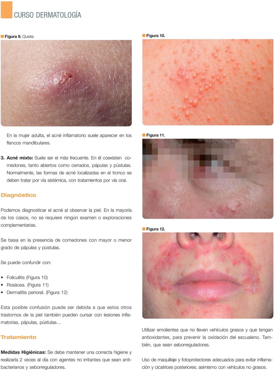 Diagnóstico Podemos diagnosticar el acné al observar la piel. En la mayoría de los casos, no se requiere ningún examen o exploraciones complementarias. Figura 12.