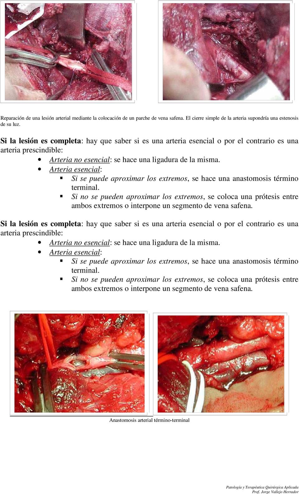 Arteria esencial: Si se puede aproximar los extremos, se hace una anastomosis término terminal.