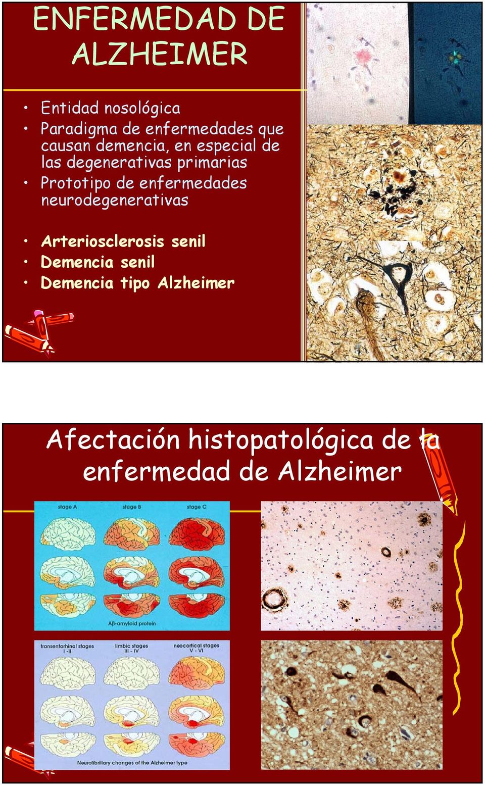 enfermedades neurodegenerativas Arteriosclerosis senil Demencia senil