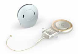 VIBRANT SUNDBRIDGE SUNDBRIDGE es un implante auditivo que consta de un implante y de un procesador de audio.