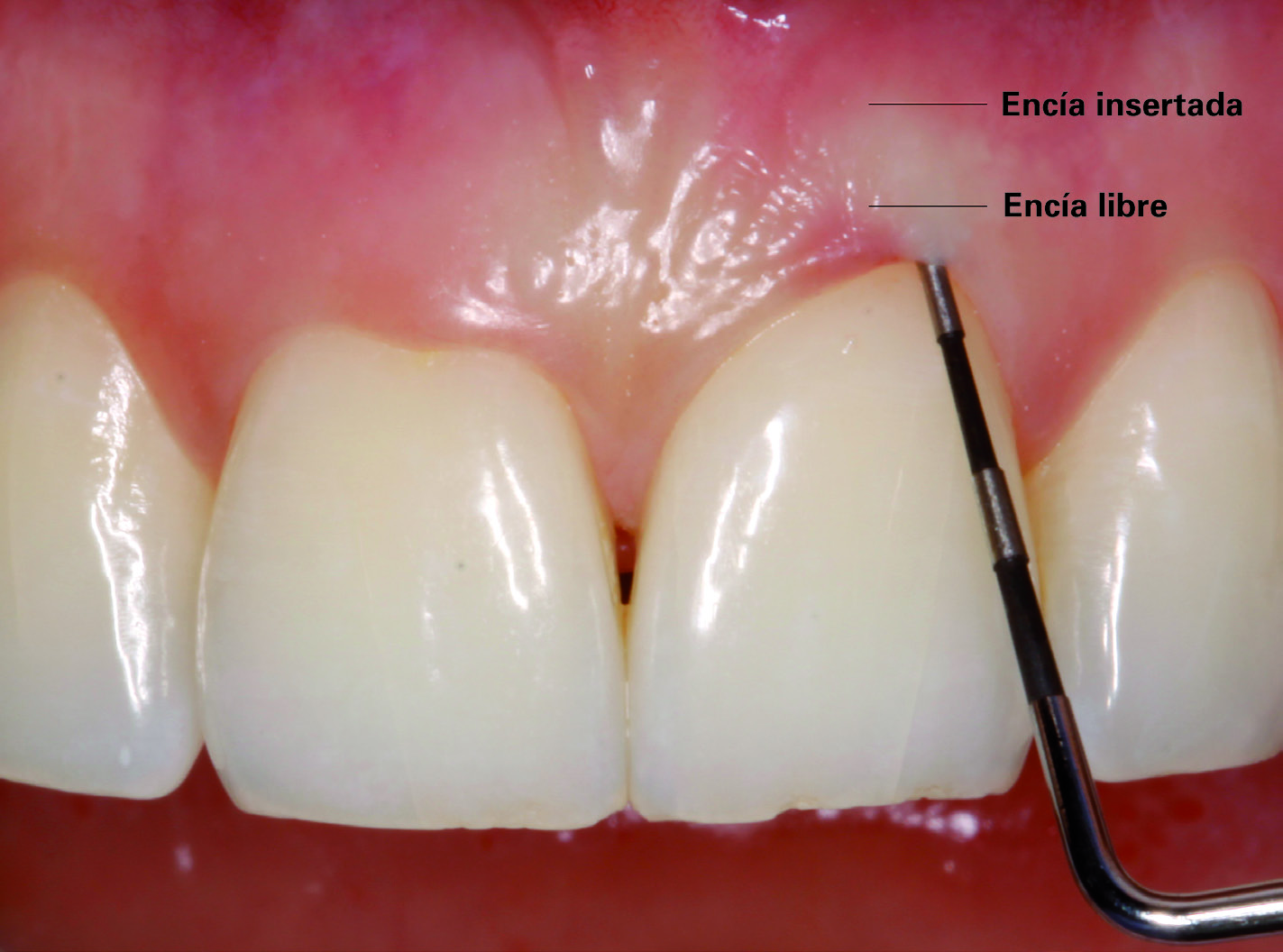 Reconocimiento de la enfermedad periodontal 91 no se presente de forma espontánea y ayuda a detectar la presencia de exudado gingival (permite además detectar la ausencia de pérdida de inserción y