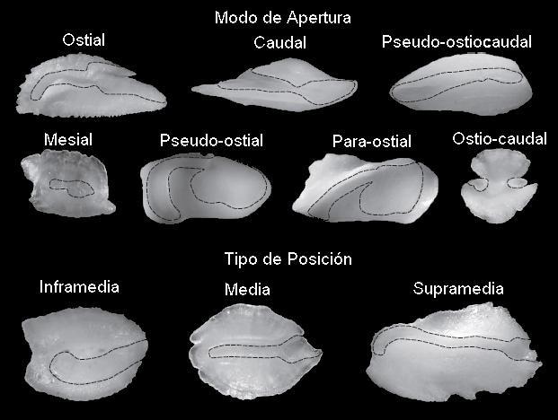 Figura 9. Términos utilizados para describir los diferentes tipos de sulcus acusticus (sulcus delimitado por una línea discontinua) (modificada de Tuset, 2008). Inframedia.