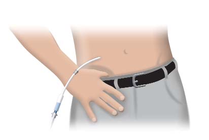 Información para el paciente de Enfermedad Crónica (ERC) Catéter para Diálisis Peritoneal El médico inserta un tubo pequeño y blando, llamado catéter, en su abdomen hasta la cavidad peritoneal.