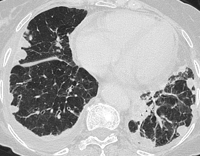 Paciente afecta de AR en tratamiento con anti-tnf Nódulos pulmonares con base pleural Cambios fibróticos peribroncovasculares con ectasias bronquiales en