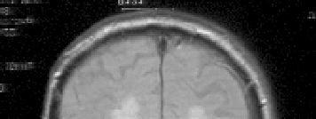Resultados 90 A B C D Figura 21. Resonancia magnética cerebral de un paciente de 81 años con diagnóstico clínico de enfermedad de Binswanger.