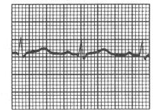 4.1.5 Electrocardiograma normal en la derivación AvL.
