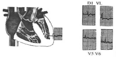 Figura 13. Vector Isquemia Subepicárdica Fuente: CASTAÑO VALENCIA.,Oscar. Electrocardiografía Básica.1993. Pág.182.