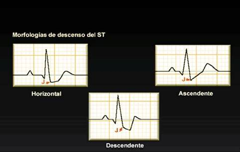 4.6 EL ELECTROCARDIOGRAMA EN LA ANGINA La clasificación funcional de la angina se define como estable o inestable. 4.6.1 Estable.