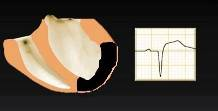 una onda Q patológica durante un infarto transmural se explica por el desarrollo en la zona infartada de un vector de despolarización que se aleja de la zona del infarto, mostrándole la cola negativa.