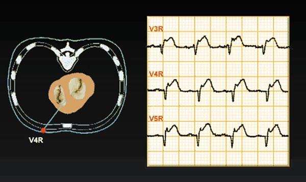 Figura 36. Signos electrocardiográficos de infarto ventricular derecho. Fuente: Medical e-health System.El Electrocardiograma en la cardiopatía isquémica. En:. Guía tutor Electrocardiograma.