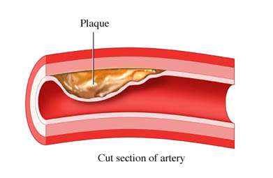 RUTAS DEL COLESTEROL Placa o ateroma de colesterol Corte de una sección arterial Las lipoproteínas de baja densidad (LDL) transportan el colesterol