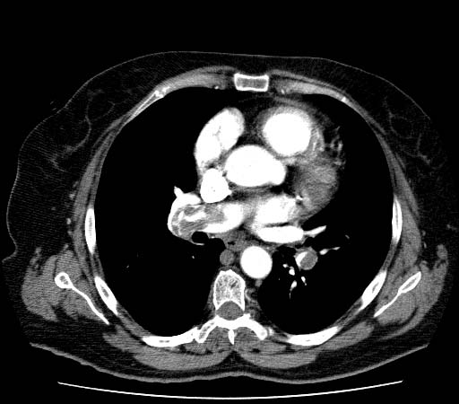 Tromboembolismo pulmonar: Hallazgos con angiotc en el