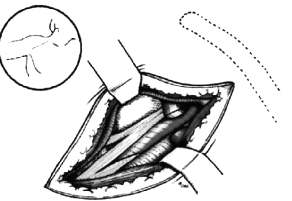 Perfusión a través de la arteria subclavia derecha en patología quirúrgica de la aorta ascendente la circulación extracorpórea y sin retirar la pinza aórtica (técnica cerrada) (Fig. ).