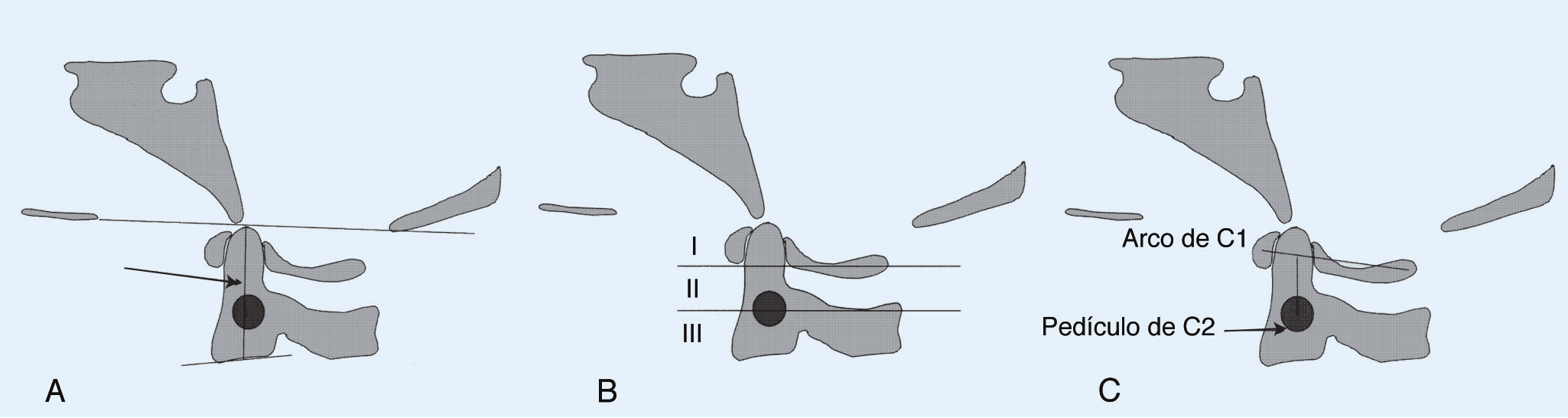 Capítulo 74: Artritis inflamatorias de la columna vertebral Figura 2 Ilustraciones que representan los métodos para valorar la invaginación basilar. A, Criterio de Redlund-Johnell.