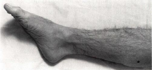 Figura 10. Punto de inserción de la aguja de electromiografía para el examen del musculo Abductor pollicis brevis. 6.14.