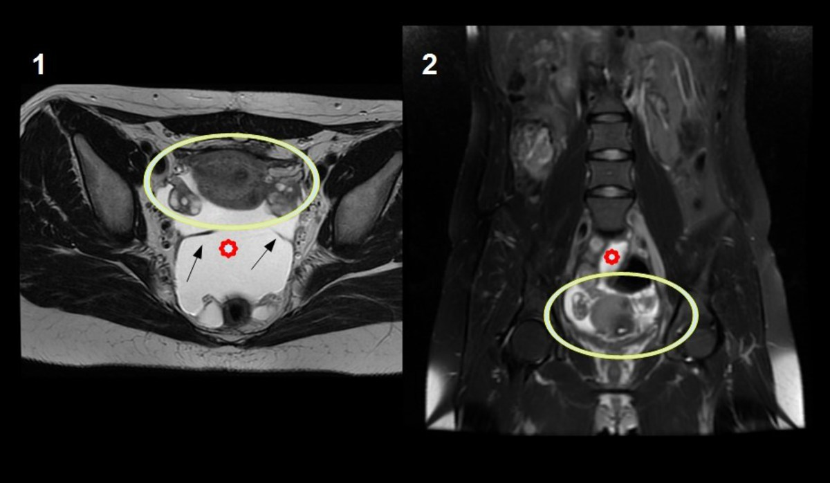 Fig. 14: Mesotelioma peritoneal quístico benigno. Imágenes de RM.