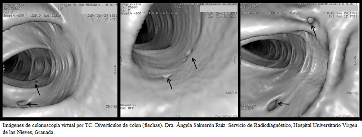Fig. 1: Imágenes de colonoscopia virtual por TC. Diveríticulos de colon (flechas). Dra. Ángela Salmerón Ruiz. Servicio de Radiodiagnóstico, Hospital Universitario Virgen de las Nieves, Granada.