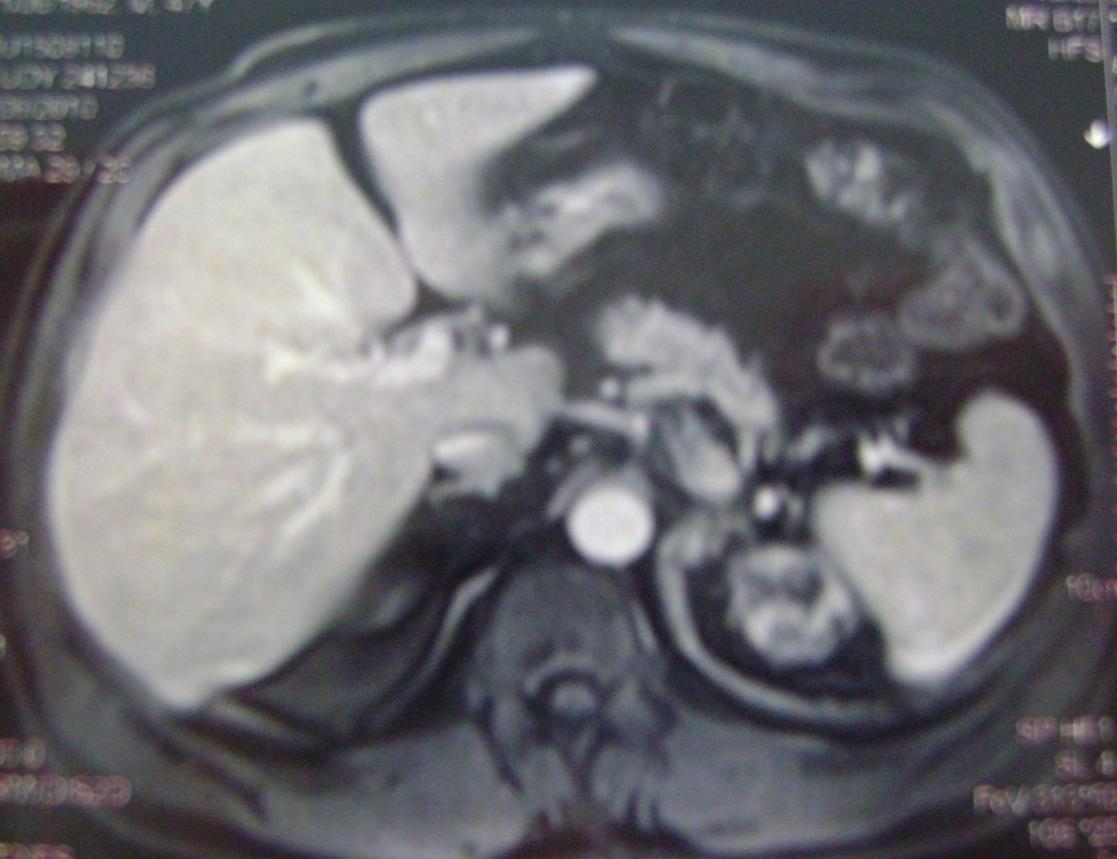 Paciente 1: RM 15/06/10 Masa en glándula suprarrenal izquierda de 3.