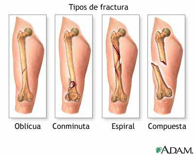 3. Según el trazo de la fractura Transversales: la línea de fractura es perpendicular al eje longitudinal del hueso.
