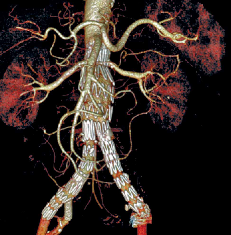 endovasculares ENERO - ABRIL 2012 Reparación endovascular de aorta torácica, alternativa de manejo para pacientes con disección aórtica aguda tipo B no complicada Tecnica propia: Laser endoluminal y