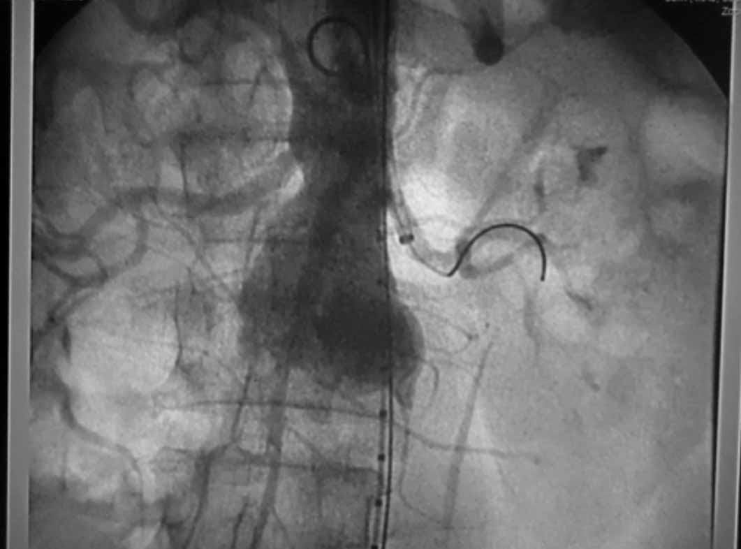 Enero-Abril 2012-4136-4146 Cesar E Jimenez MD, et al. Tecnica de chimenea para aneurismas de aorta abdominal Fig. 2: Colocación del introductor en la renal izq.