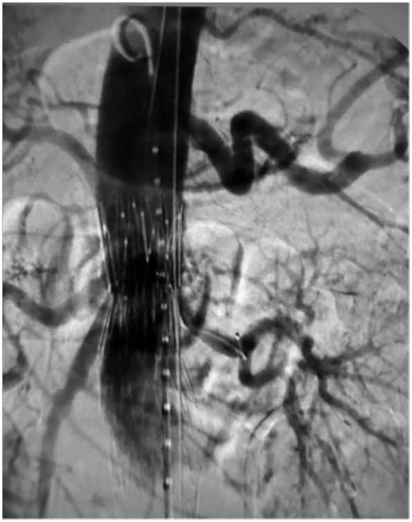 Enero-Abril 2012-4136-4146 Cesar E Jimenez MD, et al. Tecnica de chimenea para aneurismas de aorta abdominal los stents cubiertos, de otra manera la liberación se haría dentro de los introductores.