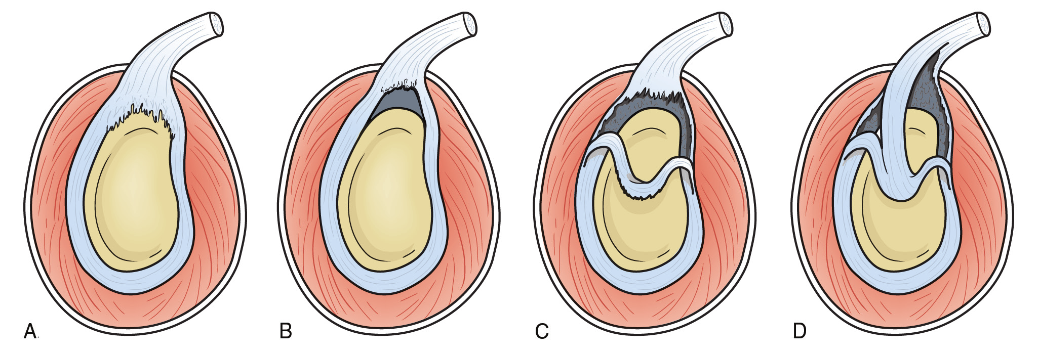 Capítulo 84: Desgarros anteroposteriores del reborde superior del rodete glenoideo y lesiones del tendón proximal del bíceps Figura 2 Ilustraciones que representan los cuatro tipos de desgarros