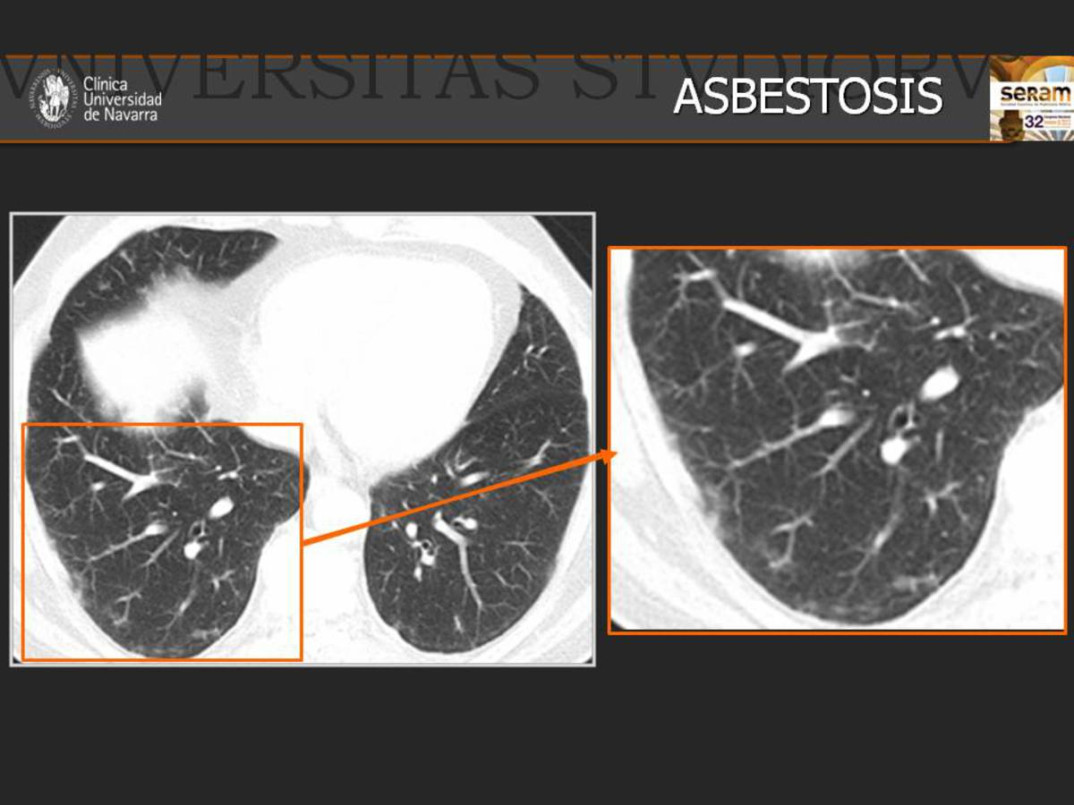 Fig. 21: TC de tórax en el que se observan infiltrados pulmonares periféricos y predominantemente bibasales, que en el