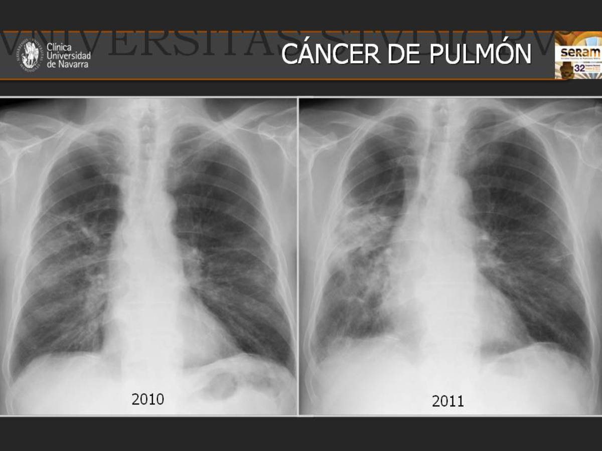 Fig. 23: Radiografías simples de tórax en paciente con antecedentes de exposición al asbesto.