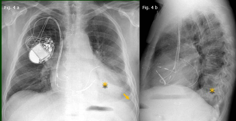 Paciente masculino 65 años Antecedentes de Insuficiencia cardíaca congestiva y múltiples derrames pleurales Fig. 4: Radiografia de tórax. a. (frente) b.