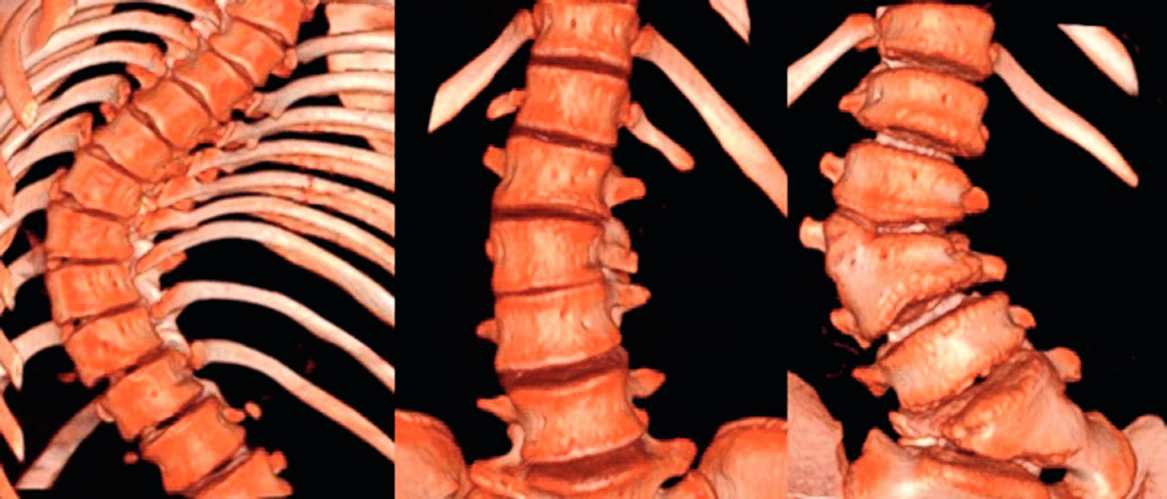Tomografía computarizada y resonancia magnética en las enfermedades dolorosas del raquis 125 Figura 10 (flechas). T 3. ) Escoliosis idiopática. ) Escoliosis secundaria a bloque incompleto (flecha).