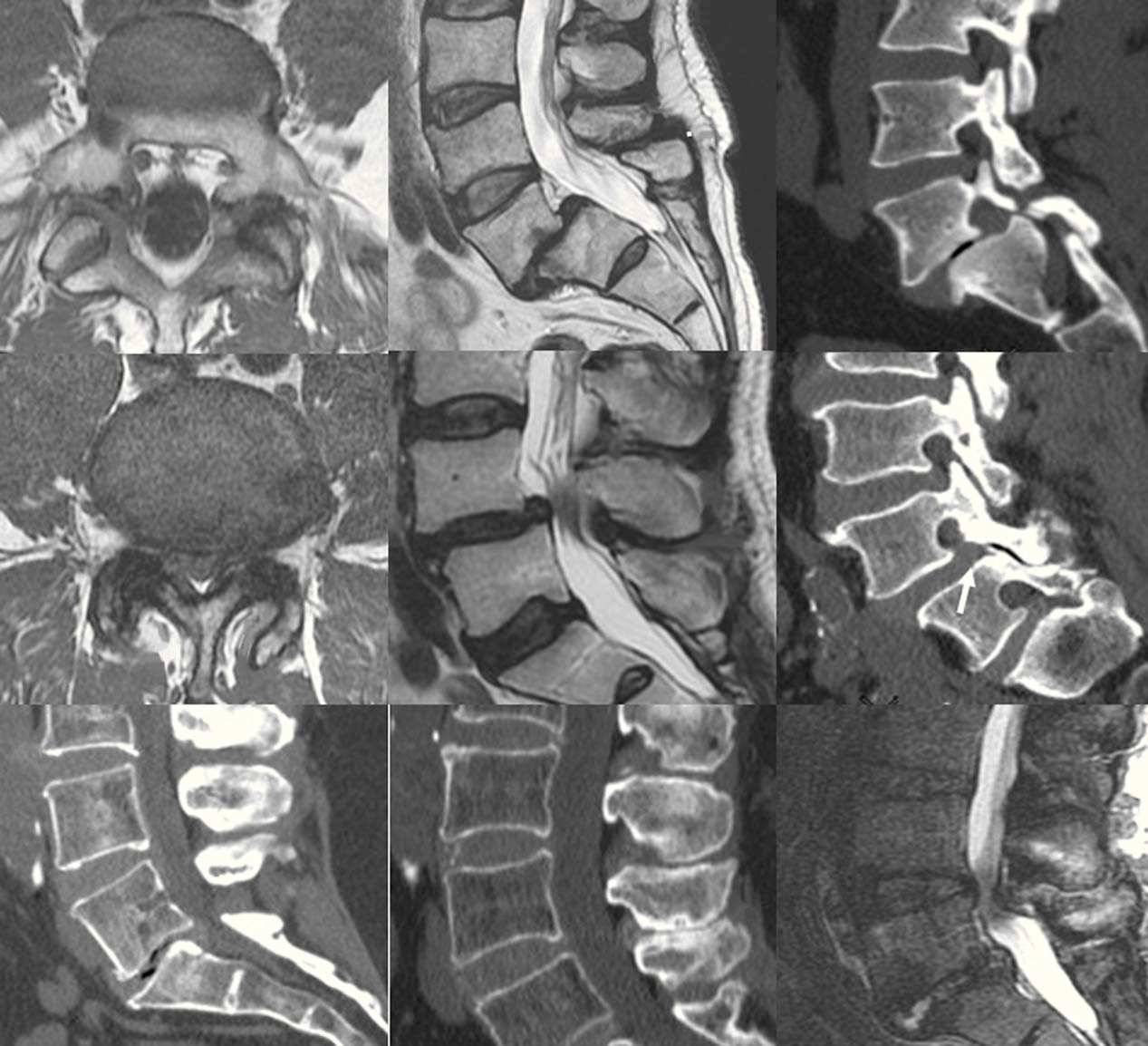 Tomografía computarizada y resonancia magnética en las enfermedades dolorosas del raquis 127 E F G H I Figura 11 Lisis ístmica con espondilolistesis.