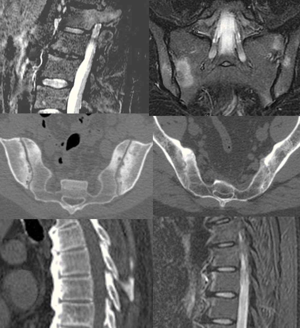128 F. Ruiz Santiago et al E F Figura 12 Espondilitis anquilosante. ) RM sagital STIR demostrando edema en los márgenes vertebrales y articulación costovertebral (flechas).