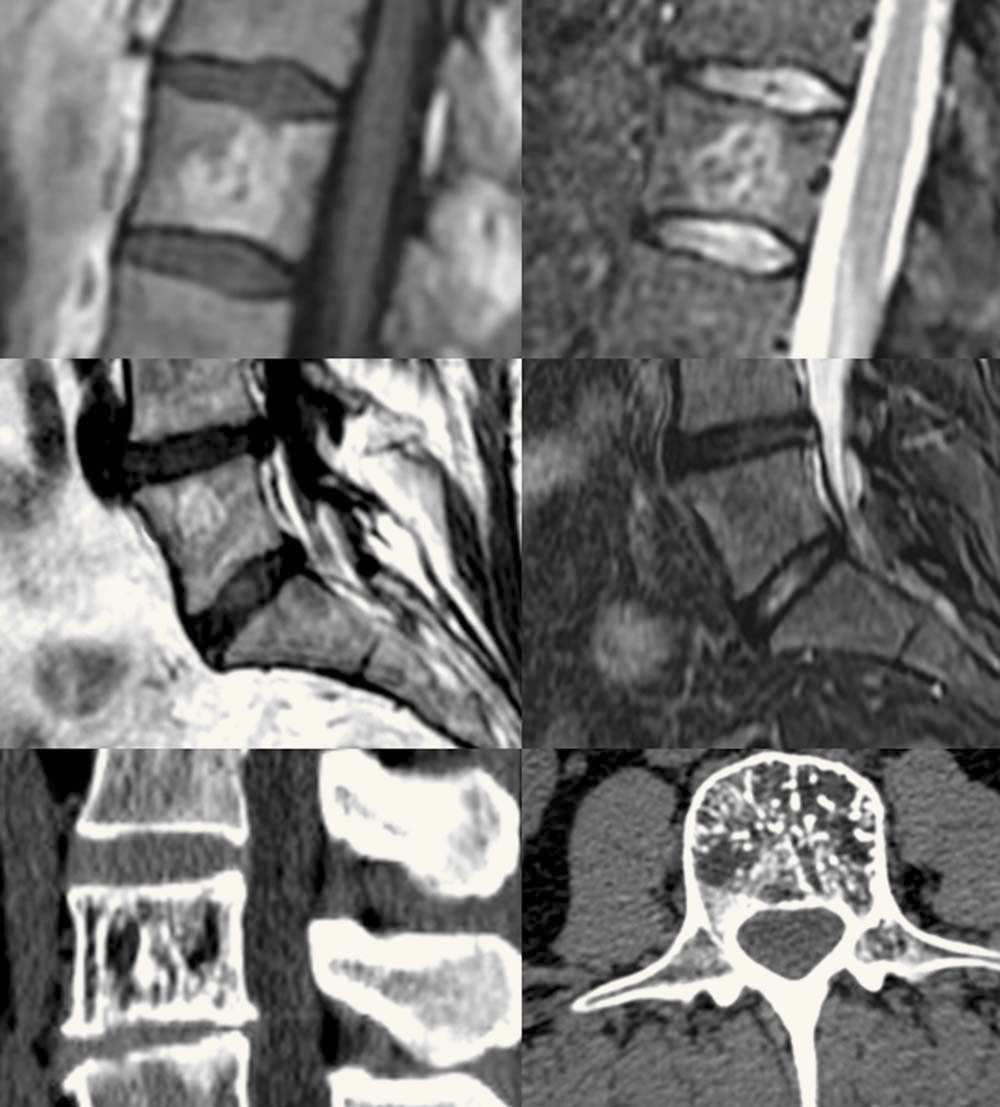 Tomografía computarizada y resonancia magnética en las enfermedades dolorosas del raquis 129 Figura 13 Osteoma Osteoide. ) RM que demuestra edema hiperintenso en STIR (flecha).