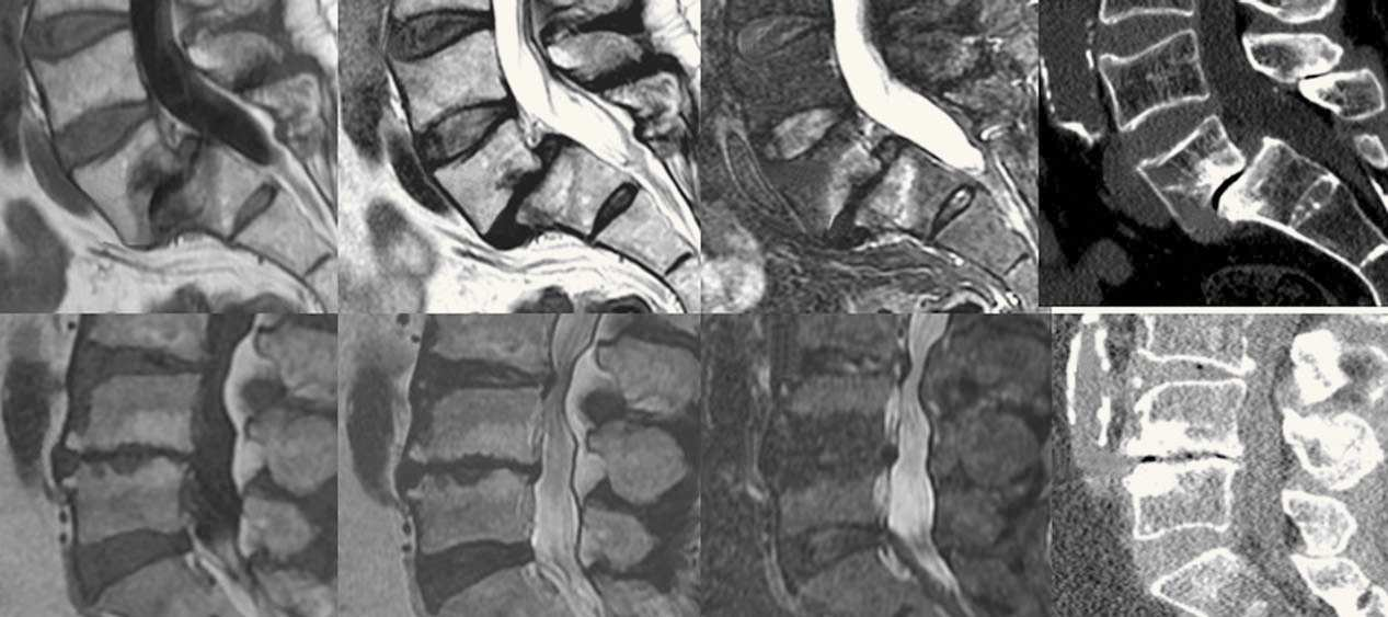 Tomografía computarizada y resonancia magnética en las enfermedades dolorosas del raquis 121 Figura 5 Enfermedad discal en plano sagital. RM T2. ) Protrusión discal.