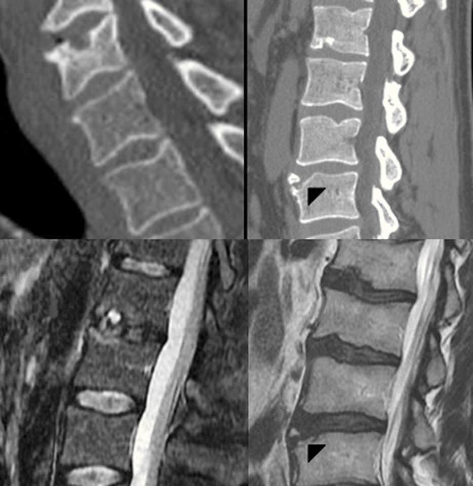 122 F. Ruiz Santiago et al Figura 7 ) T sagital con hernia de Schmorl cervical (flecha). ) T sagital con hernias de Schmorl lumbar (flechas). Hernia retromarginal (cabeza de flecha) ().