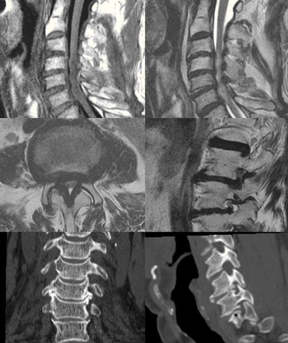 Tomografía computarizada y resonancia magnética en las enfermedades dolorosas del raquis 123 E F Figura 8 Sagital T1 () y T2 () con estenosis de canal central y mielopatía (flecha).
