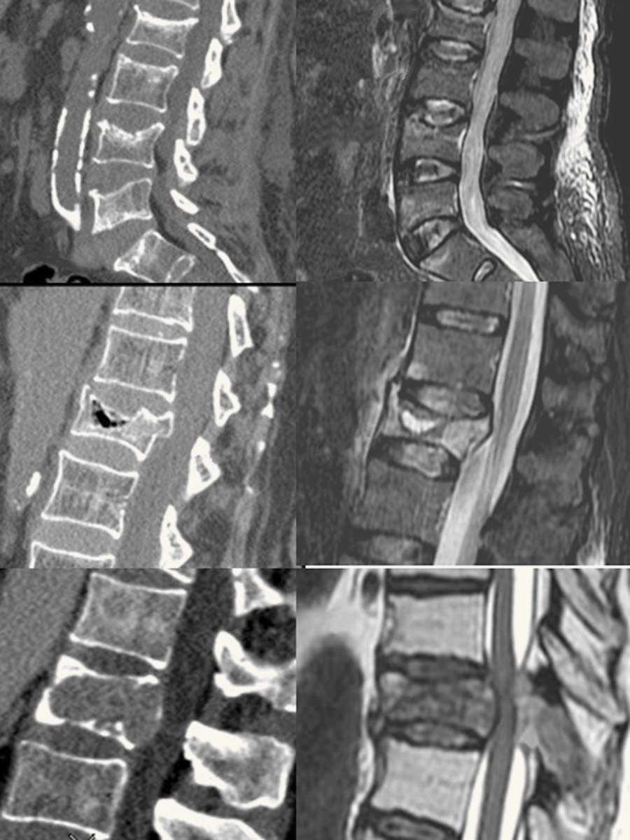 124 F. Ruiz Santiago et al E F Figura 9 -) Fracturas por insuficiencia en osteoporosis.