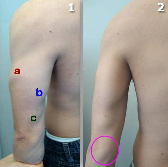 El músculo Braquial Anterior se palpa en la cara medial del brazo cuando el paciente, con el codo flexionado, realiza un movimiento de flexión y aducción del hombro contra la resistencia del