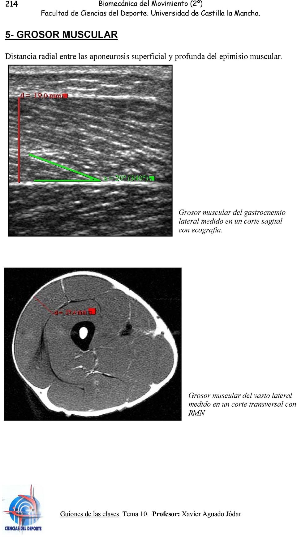 Grosor muscular del gastrocnemio lateral medido en un corte sagital con