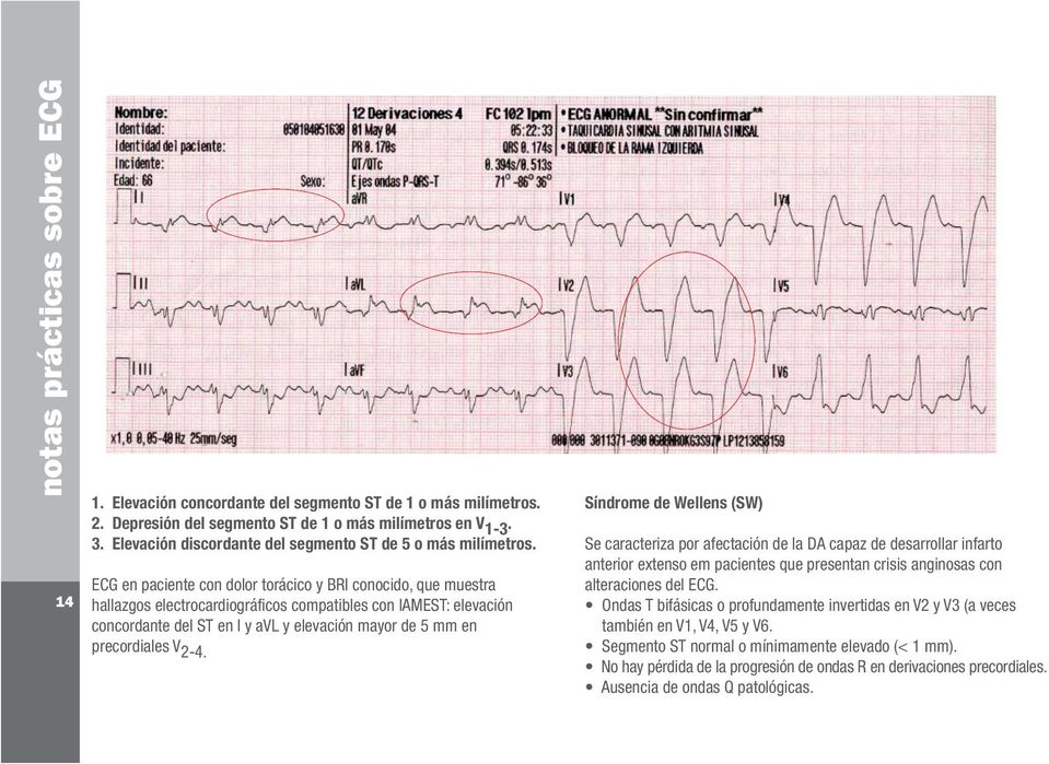 ECG en paciente con dolor torácico y BRI conocido, que muestra hallazgos electrocardiográficos compatibles con IAMEST: elevación concordante del ST en I y avl y elevación mayor de 5 mm en
